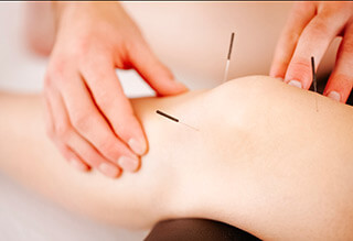 acupuncture picture